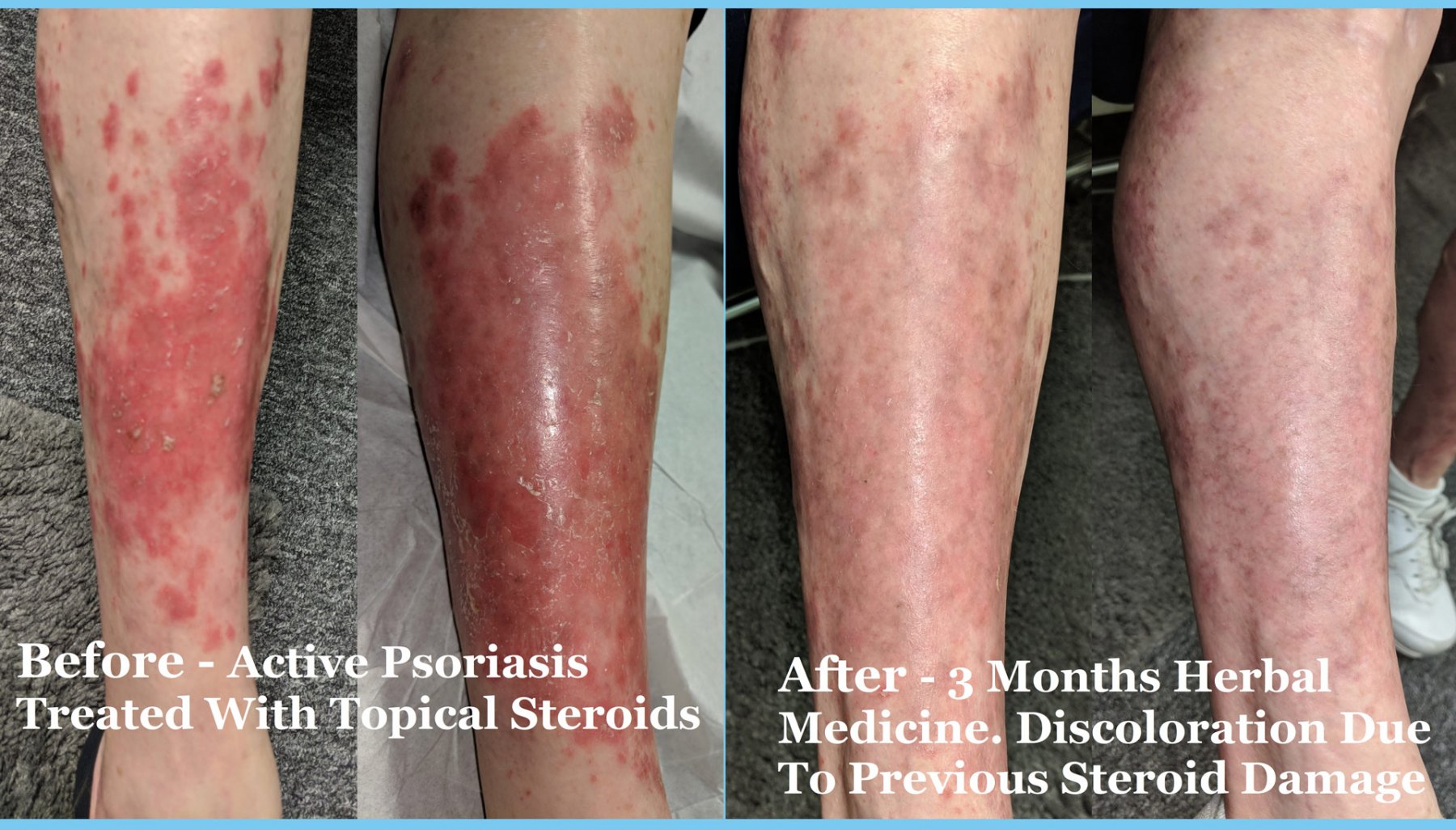 Leg-Psoriasis-Before-After-Text