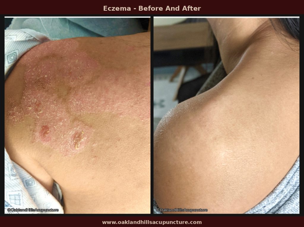 Eczema before and after treatment — shoulder area showing improvement after 4 months of Chinese herbal medicine at Oakland Hills Acupuncture.