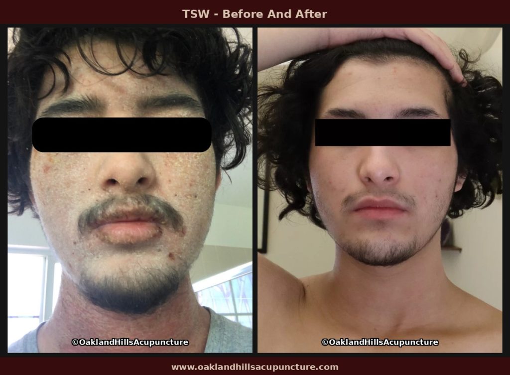 TSW before and after — facial scales, crust, and erythema resolved after 8 weeks of Chinese herbal medicine at Oakland Hills Acupuncture.