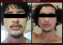 Before and after photos of topical steroid withdrawal treatment with Chinese herbal medicine at Oakland Hills Acupuncture