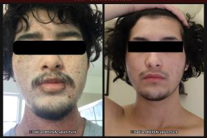 Before and after photos of topical steroid withdrawal treatment with Chinese herbal medicine at Oakland Hills Acupuncture