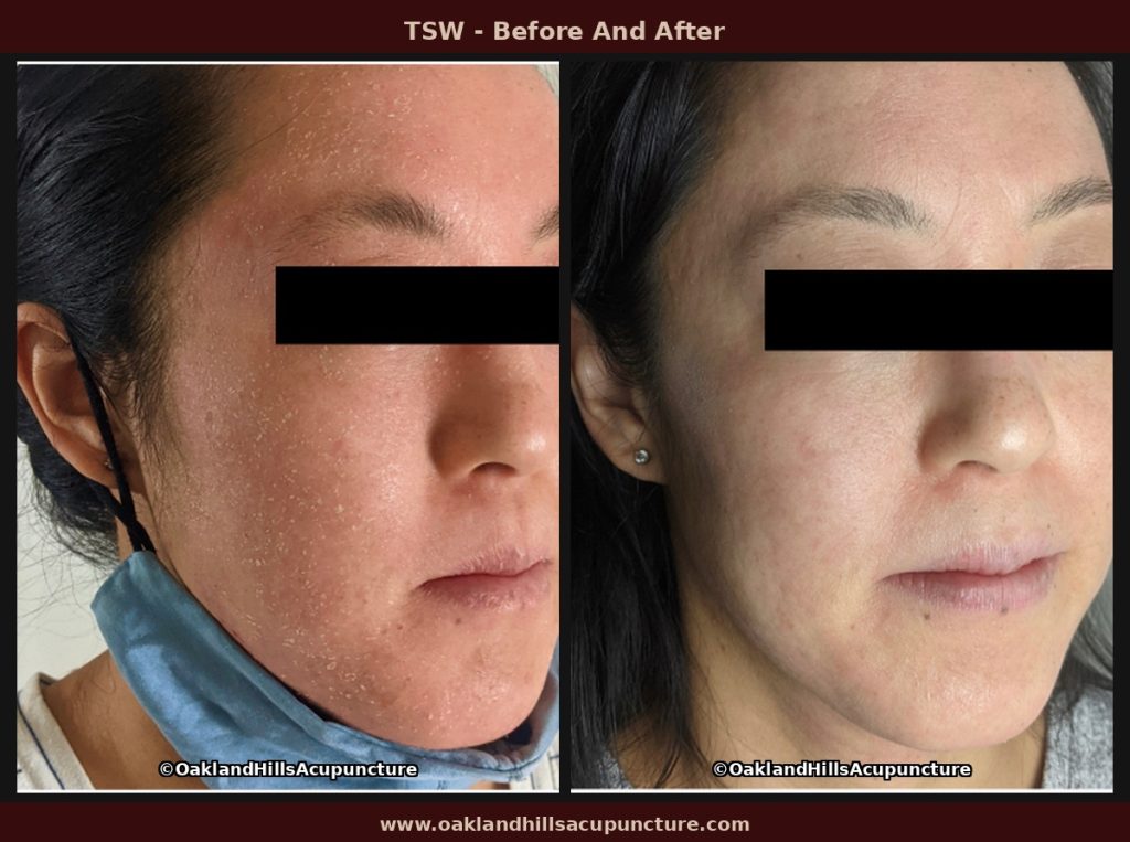 TSW before and after — facial redness and flaking resolved after 4 months of Chinese herbal medicine treatment at Oakland Hills Acupuncture.