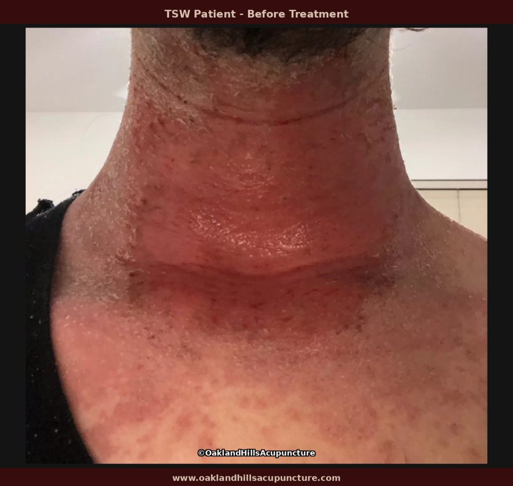 Severe topical steroid withdrawal showing neck erosion and erythema before Chinese herbal medicine treatment.