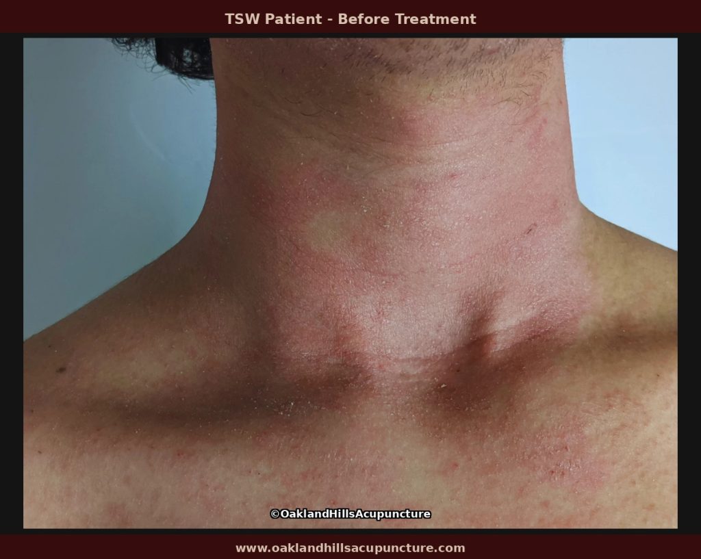Erythematous papules on neck and chest typical of TSW papulopustular pattern before treatment at Oakland Hills Acupuncture.